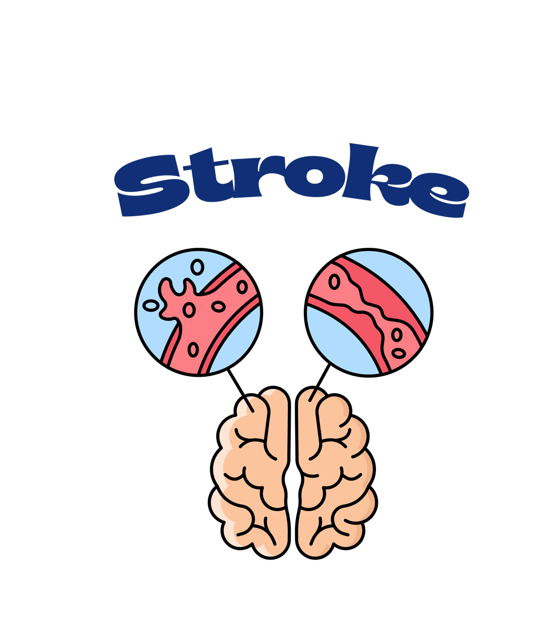 STROKE: How It Affects the Brain, the Problems It Causes & The Lifestyle Changes That Protect You